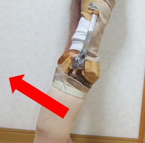 「ローテーション」という義足ですが、足の甲部分が伸びきらずに後方部分が出っ張っておりました。