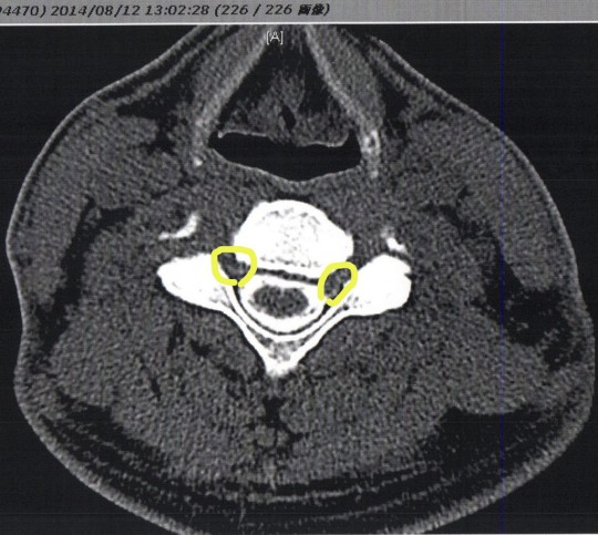 画像は首のCT断面図、白い部分が脊髄に相当し、黄色い印の辺りに漏れを確認