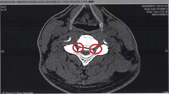 【脳脊髄液の漏れを説明するために用意頂いたMRI画像、赤丸部分に漏れが認められた】
