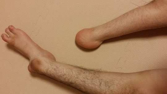 左足には指3本。右足は足首で切断、ヒザは曲がらず。